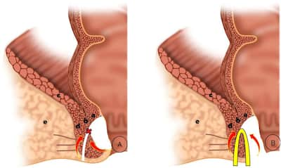 Intersphincteric Resection: A Stoma-Free Solution for Rectal Cancer with Improved Quality of Life