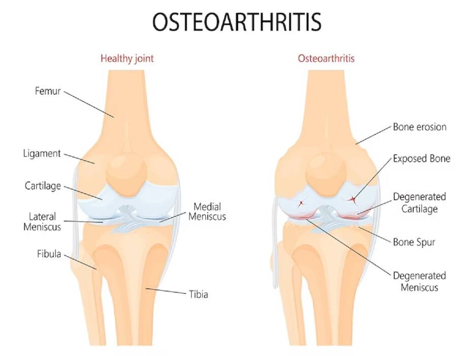 Can Knee Arthritis Increase Your Risk Of Getting A Hip Fracture?