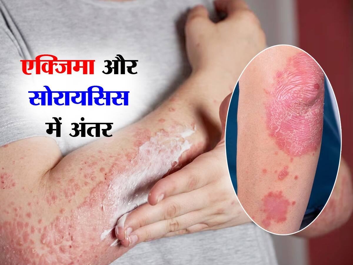 psoriasis-vs-eczema-in-hindi