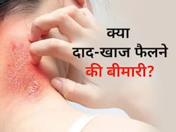  क्या दाद एक व्यक्ति से दूसरे व्यक्ति में फैल सकता है? जानिए किस तरह करें इससे बचाव