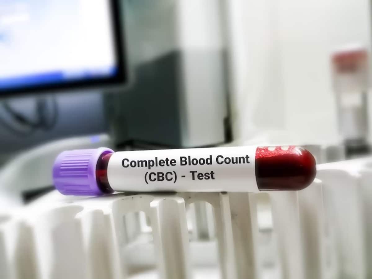 Aplastic Anemia: A Rare Disorder With Severely Low Blood Cell Count - Vimarsana News