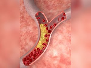 पैरों पर नजर आने वाले ये 10 लक्षण जो High Cholesterol का संकेत देते है