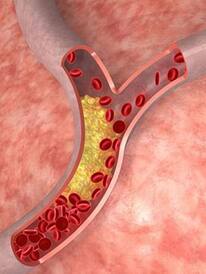 पैरों पर नजर आने वाले ये 10 लक्षण जो High Cholesterol का संकेत देते है