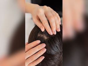 Scalp Psoriasis: How To Cope With Psoriasis Induced Hair Loss?