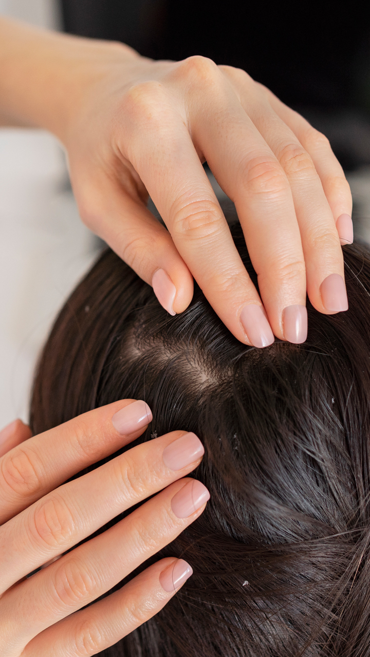 Scalp Psoriasis: How To Cope With Psoriasis Induced Hair Loss?