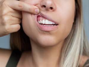 Guardians Of Gums: Mastering The Art Of Effective Oral Hygiene To Prevent Gum Infections