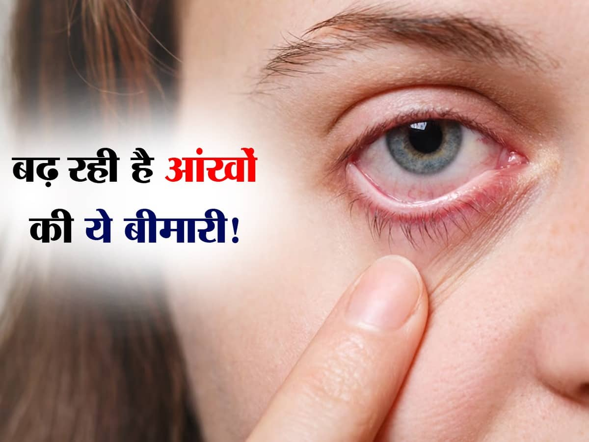 Eye Flu Symptoms In Hindi 