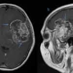 High-grade gliomas (HGGs)