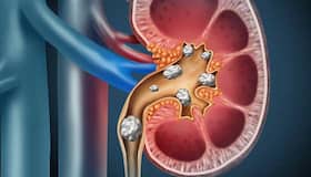 Kidney Stone: पथरी से अगर जिंदगी भर बचना है तो भूलकर भी न खाएं ये 6 चीजें