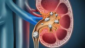 Kidney Stone: पथरी से अगर जिंदगी भर बचना है तो भूलकर भी न खाएं ये 6 चीजें