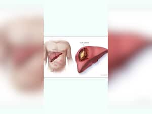 10 Symptoms That You May Be Suffering From Liver Cancer