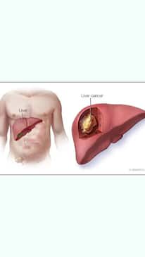 10 Symptoms That You May Be Suffering From Liver Cancer