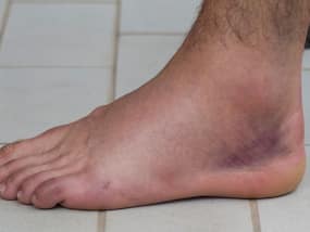 How To Heal A Sprained Ankle Overnight - 5 tips