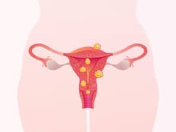 Uterine Fibroids: Expert Highlights Potential Causes Of Underdiagnosis And Decline In Detection Rates