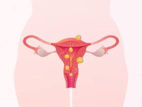 Uterine Fibroids: Expert Highlights Potential Causes Of Underdiagnosis And Decline In Detection Rates