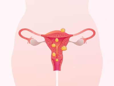 Uterine Fibroids: Expert Highlights Potential Causes Of Underdiagnosis And Decline In Detection Rates