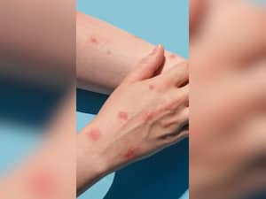 8 Food To Eat In Monkeypox Virus