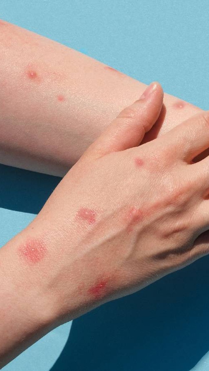 8 Food To Eat In Monkeypox Virus