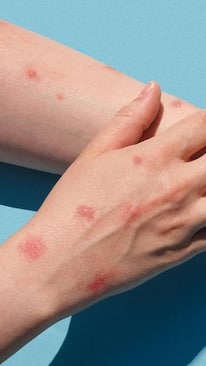 8 Food To Eat In Monkeypox Virus