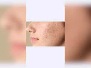 10 Common Myths About Acne And Pimples