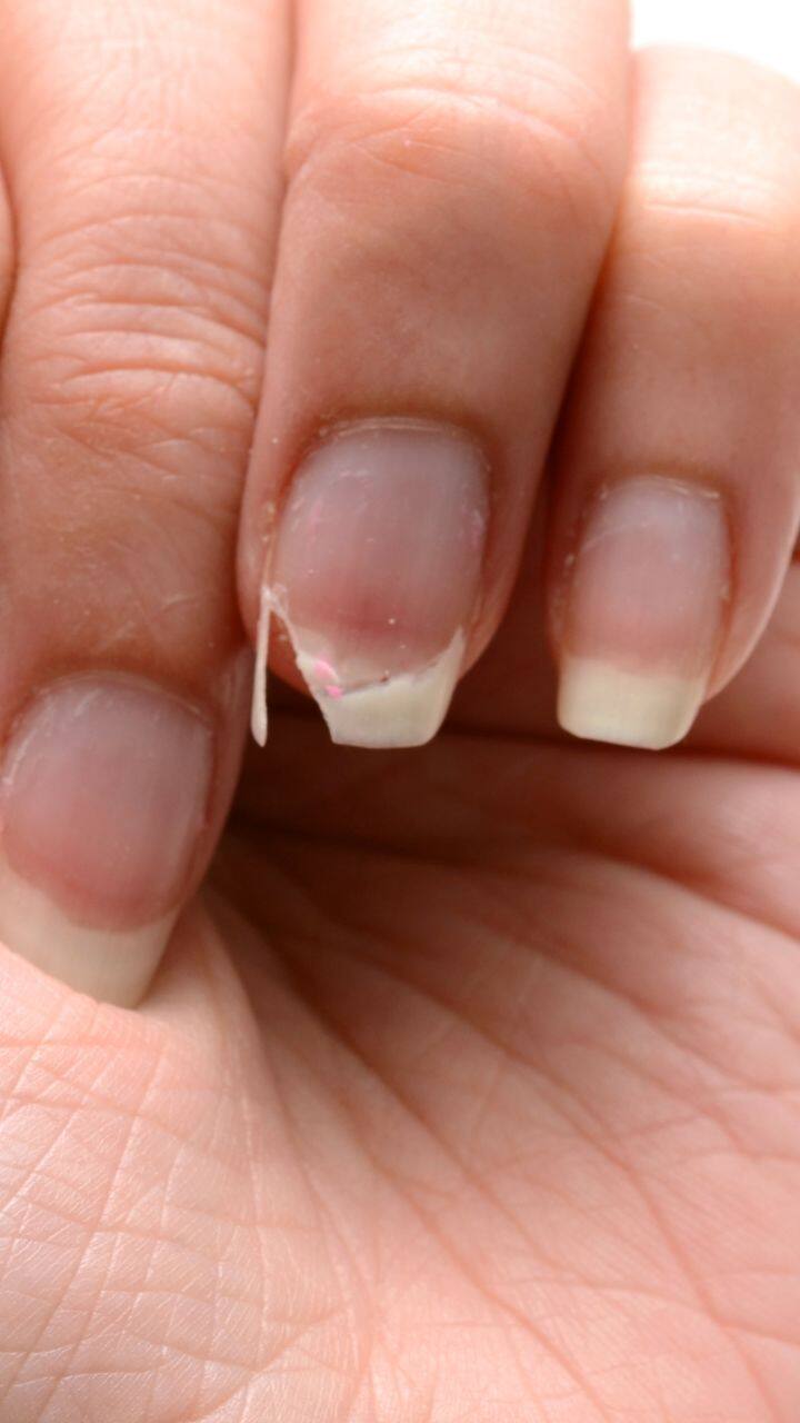Do discoloured nails mean something? | Office for Science and Society -  McGill University