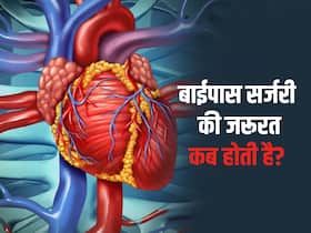 हार्ट पेशेंट को Bypass Surgery की जरूरत कब पड़ती है, जानिए बाईपास सर्जरी का पूरा प्रोसेस