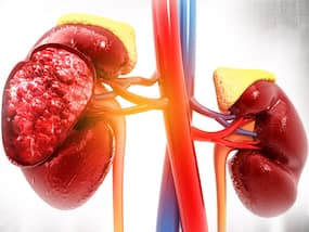 High Cholesterol Side Effects: Here's How Excessive Bad Cholesterol Affects Your Kidneys