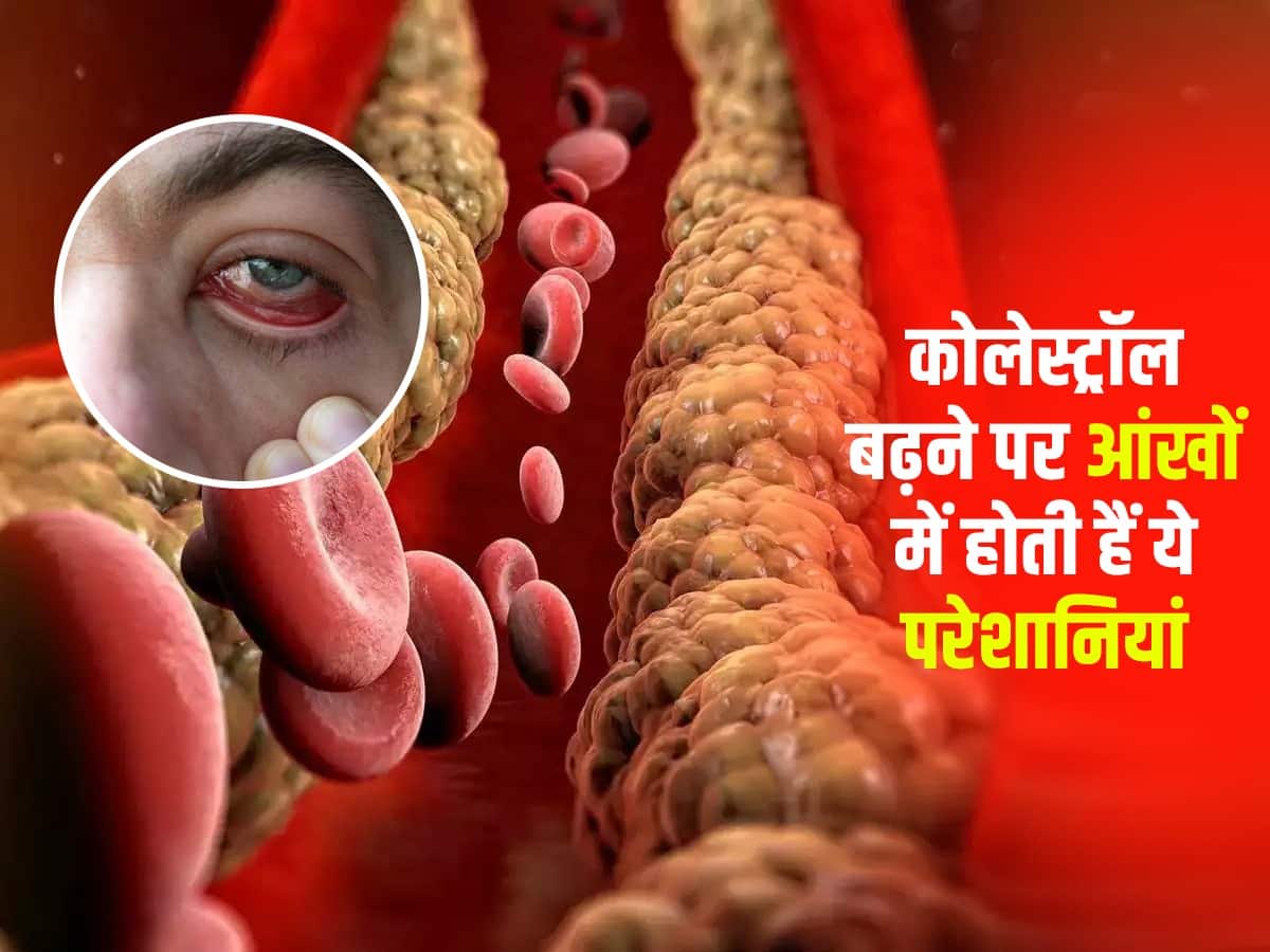 Body mein cholesterol badhane ke lakshan नसों में Bad Cholesterol