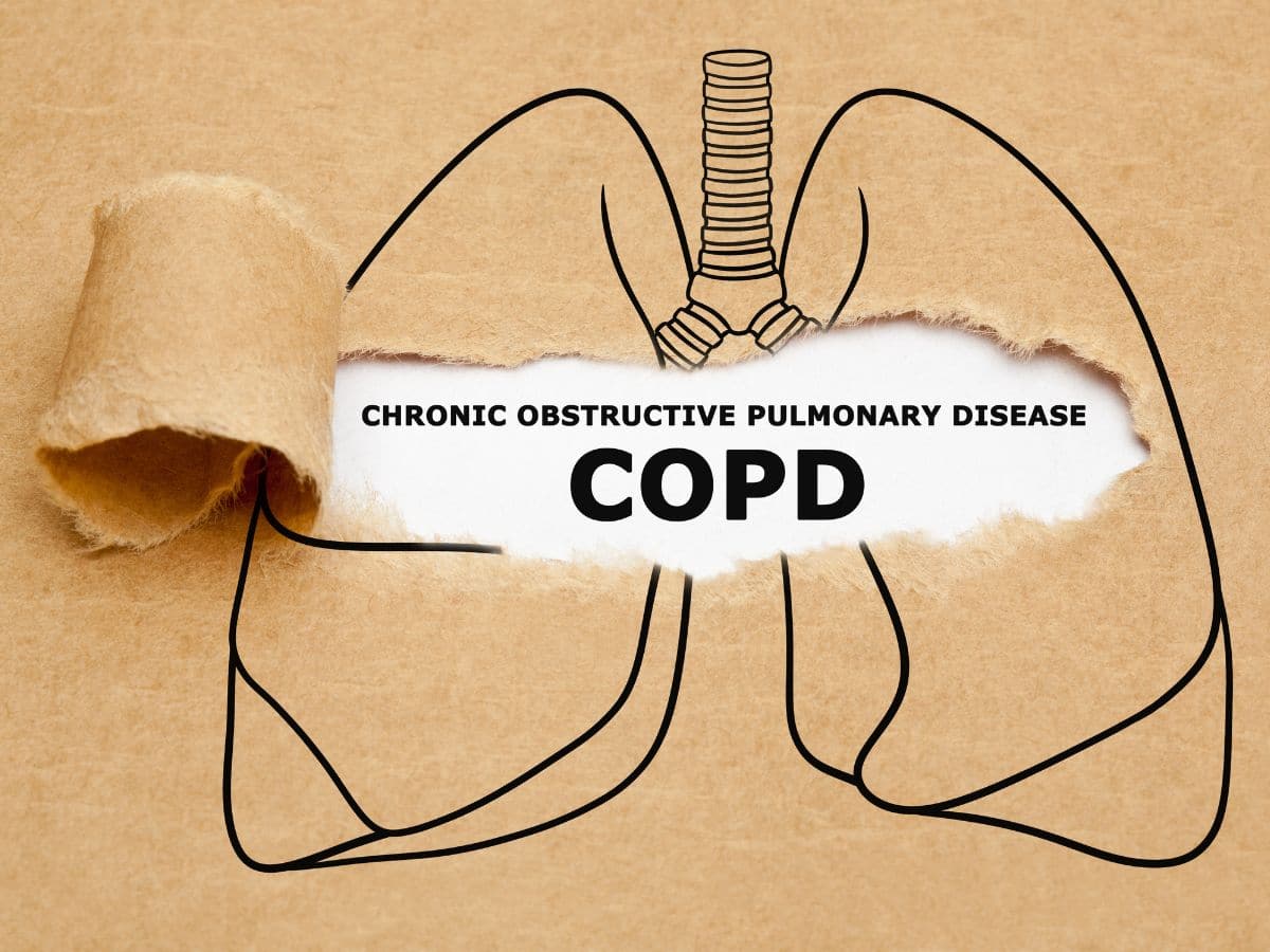 Beyond Smoking: Understanding And Treating Chronic Obstructive Pulmonary Disease