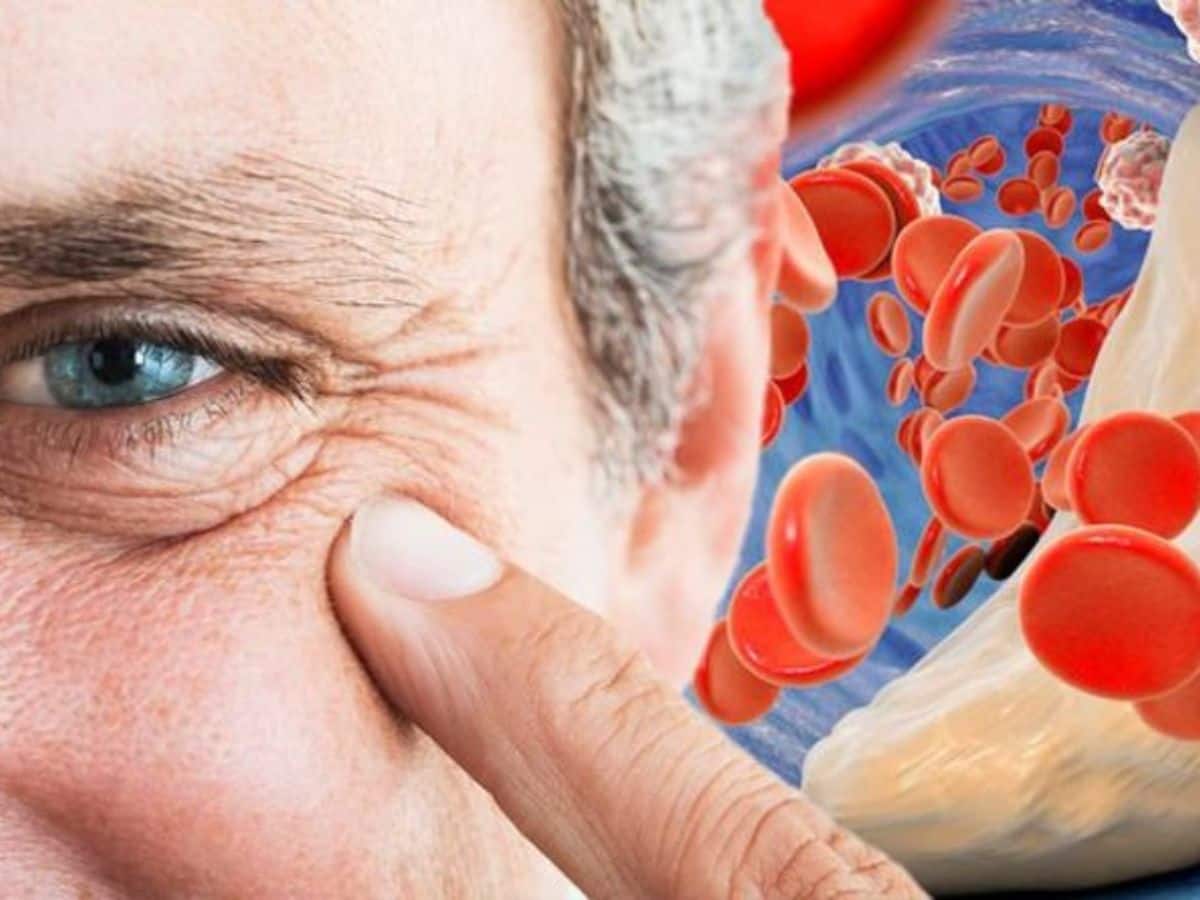 High cholesterol symptoms: THIS lesser-known sign could strike in