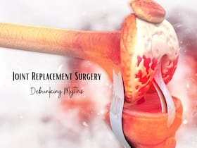 Joint Replacement Surgery: Understanding Top 5 Myths And Facts
