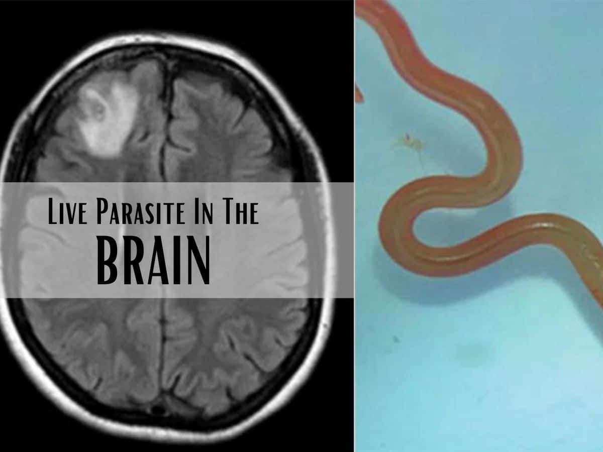 Live Parasitic Worm Found In Australian Woman's Brain In World-First Discovery