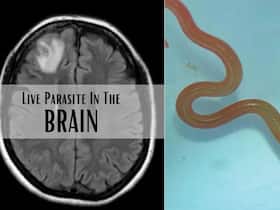 Live Parasitic Worm Found In Australian Woman's Brain In World-First Discovery Live Parasitic Worm Found In Australian Woman's Brain In World-First Discovery