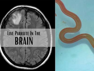 Live Parasitic Worm Found In Australian Woman's Brain In World-First Discovery