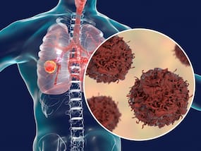 Unusual Symptoms of Lung Cancer: How To Know What Type of Lung Cancer You Have? Unusual Symptoms of Lung Cancer: How To Know What Type of Lung Cancer You Have?