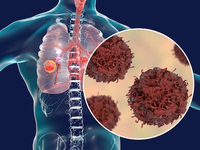 Non-Small Cell Lung Cancer Vs Small Cell Lung Cancer: Understanding The Key Differences