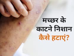 मच्छर के काटने से स्किन पर होने लगे हैं छोटे-छोटे दानें, इन नुस्खों से तुरंत पाएं आराम