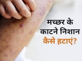 मच्छर के काटने से स्किन पर होने लगे हैं छोटे-छोटे दानें, इन नुस्खों से तुरंत पाएं आराम मच्छर के काटने से स्किन पर होने लगे हैं छोटे-छोटे दानें, इन नुस्खों से तुरंत पाएं आराम