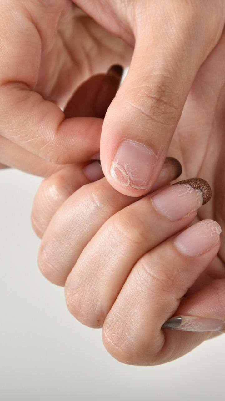 5 Signs of Vitamin B12 Deficiency on nails.