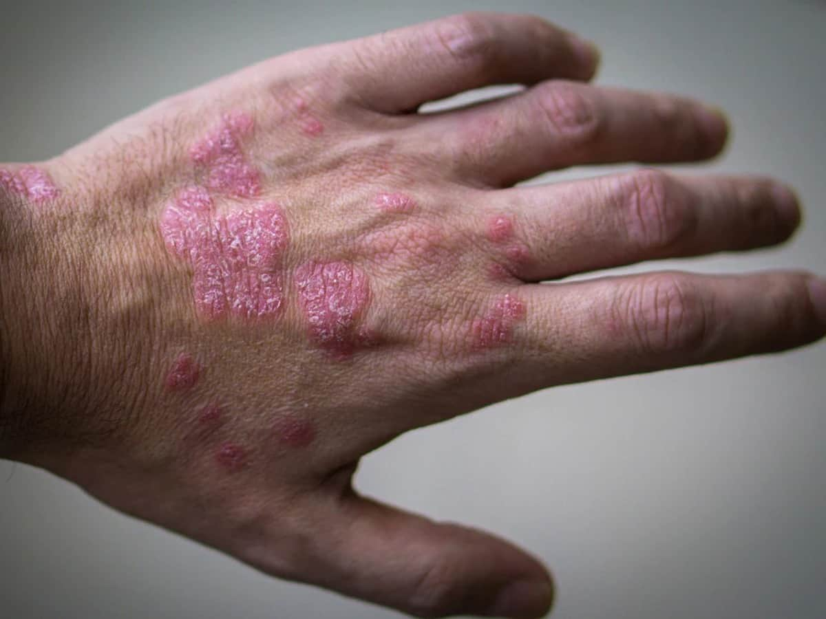 Psoriasis Causes Triggers Treatment And More