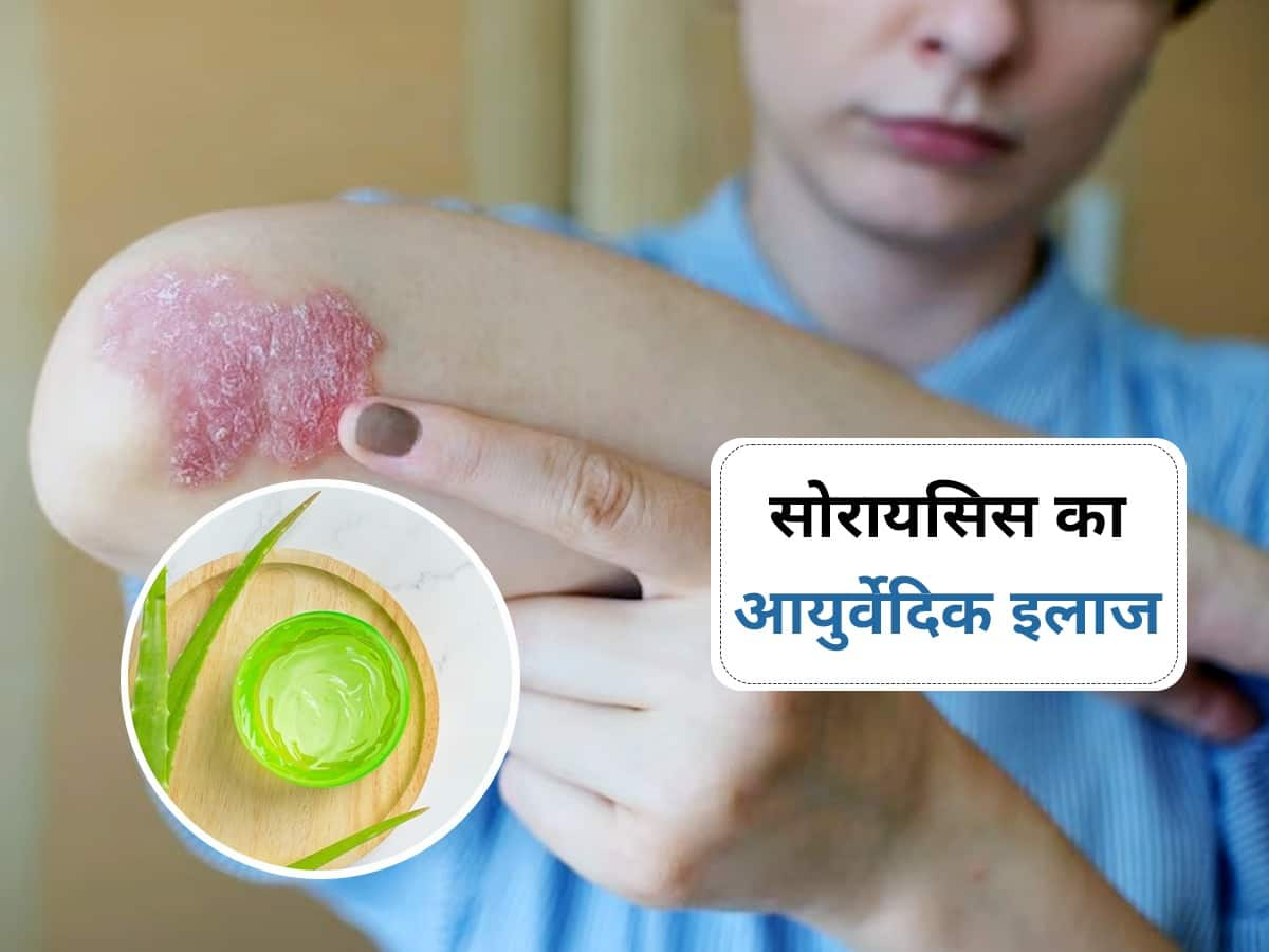 Psoriasis Ayurvedic Remedies In Hindi Psoriasis त्वचा की गंभीर बीमारी है सोरायसिस इन 5 