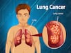 Are You At Risk Of Lung Cancer? Tests Recommended For Early Detection Of Lung Cancer
