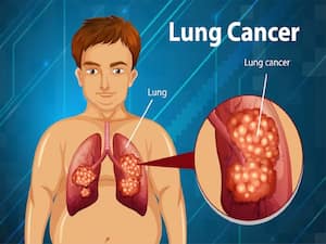 6 Advanced Test For Lung Cancer Diagnosis For Better Health - Drlogy