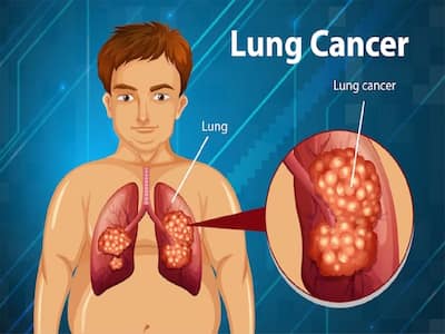 Are You At Risk Of Lung Cancer? Tests Recommended For Early Detection Of Lung Cancer