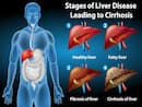 Hepatogenous Diabetes: The Connection Between Diabetes and Liver Disease Explained