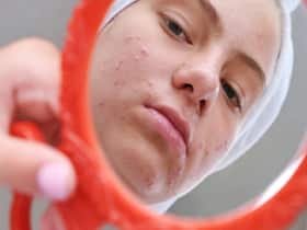 Acne In Children: Causes and Treatment Acne In Children: Causes and Treatment