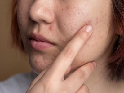 Hormonal Acne: Understanding the Connection between Hormones and Skin Health