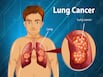 Comprehensive Care: A Look At Multidisciplinary Approaches To Lung Cancer Treatment