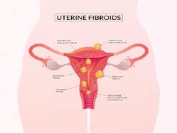 Working Women Have More Chances Of Getting Uterine Fibroids; Here   s How You Can Prevent It