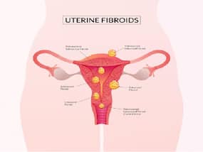 Working Women Have More Chances Of Getting Uterine Fibroids; Here   s How You Can Prevent It